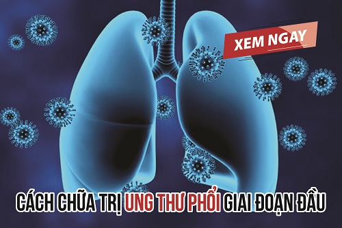 Ung thư phổi giai đoạn đầu có tỷ lệ chữa khỏi cao