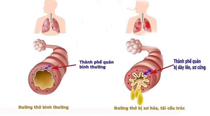    Tái cấu trúc đường thở là nguyên nhân gây viêm phổi kéo dài