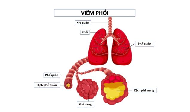 Viêm phổi là tình trạng nhiễm trùng nhu mô phổi