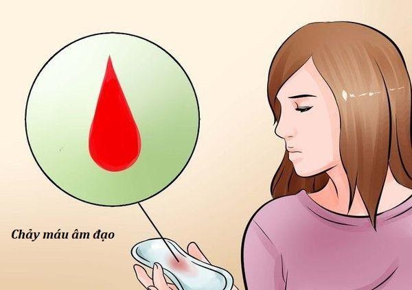 Chảy máu âm đạo là dấu hiệu cảnh báo ung thư buồng trứng