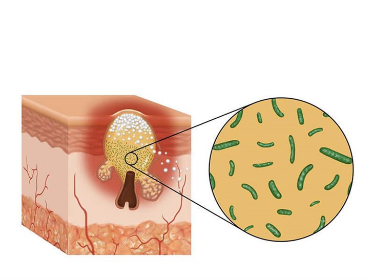   Vi khuẩn p. acnes gây mụn bọc