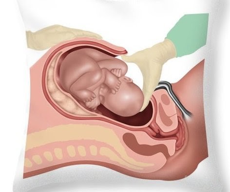 Mổ lấy thai có thể là yếu tố dẫn đến lạc nội mạc tử cung