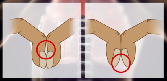Ngón tay dùi trống có thể là dấu hiệu của ung thư phổi