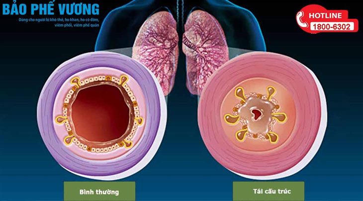   Tái cấu trúc đường thở là nguyên nhân cốt lõi gây viêm phổi ở người già