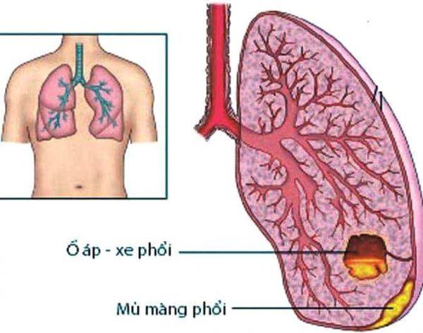   Viêm phổi có thể dẫn đến áp xe phổi