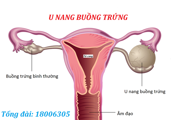 U nang buồng trứng là bệnh phụ khoa phổ biến ở phụ nữ trong độ tuổi sinh sản