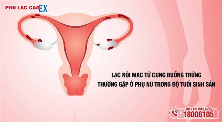 Lạc nội mạc tử cung buồng trứng thường gặp ở phụ nữ trong độ tuổi sinh sản