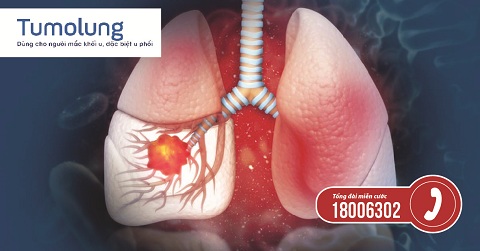 Ung thư phổi là căn bệnh nguy hiểm ngày càng có xu hướng tăng nhanh