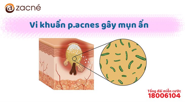 Vi khuẩn p.acnes gây mụn