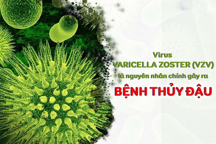 Virus Varicella - Zoster là tác nhân gây bệnh thủy đậu