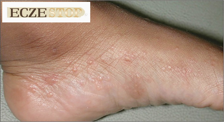 Bệnh tổ đỉa bàn chân đặc trưng bởi sự xuất hiện của những mụn nước li ti