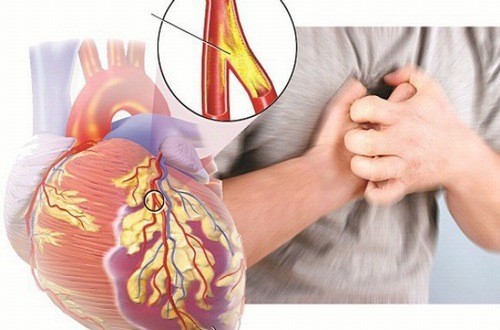 Bệnh tim mạch là yếu tố nguy cơ hàng đầu của tai biến mạch máu não