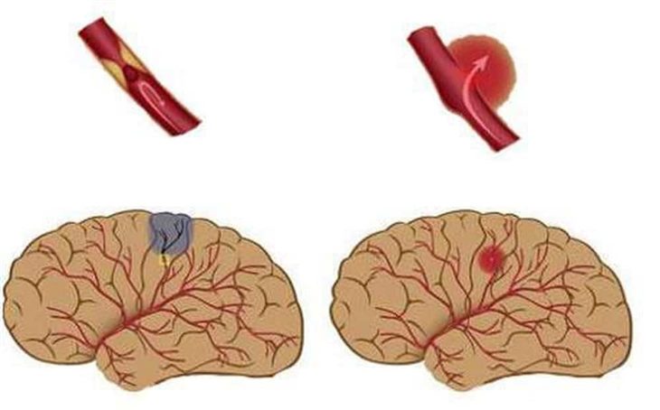 Cách điều trị tai biến mạch máu não phụ thuộc vào từng thể bệnh