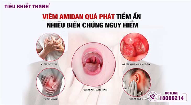 Viêm amidan quá phát tiềm ẩn nhiều biến chứng nguy hiểm