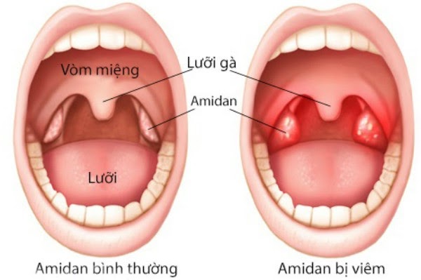 Viêm amidan là một bệnh lý đường hô hấp trên phổ biến