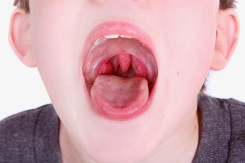 Trẻ bị đau rát họng do viêm họng
