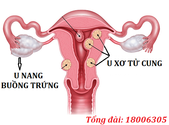 U xơ tử cung, u nang buồng trứng có thể gây rong kinh, đau bụng dưới