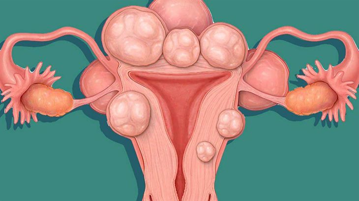 U xơ tử cung có thể gây vô sinh