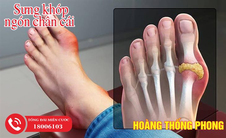 Sưng đau ngón chân cái có thể là triệu chứng của bệnh gút