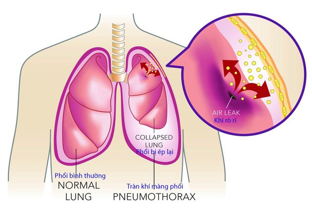   Tình trạng phù do suy thận mạn mà không được kiểm soát dễ biến chứng gây tràn dịch màng phổi