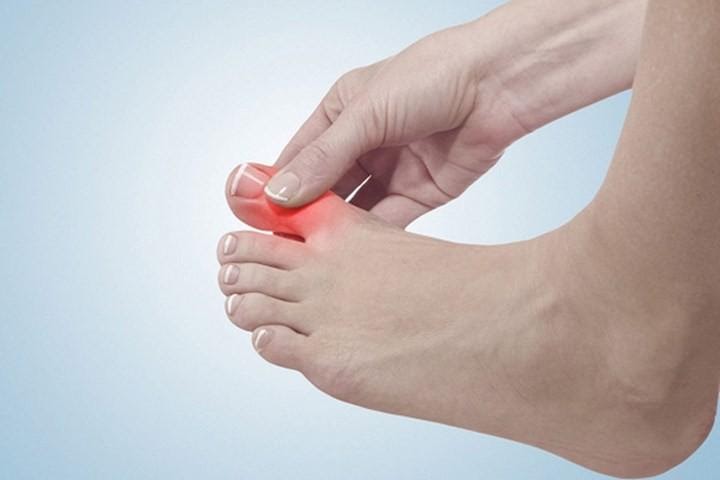 Bệnh gút gây đau ở khớp ngón chân