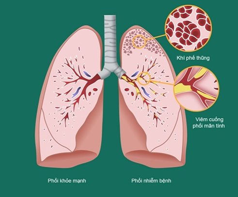 Viêm phổi tắc nghẽn mạn tính (COPD) đang trở thành gánh nặng về y tế trên toàn cầu