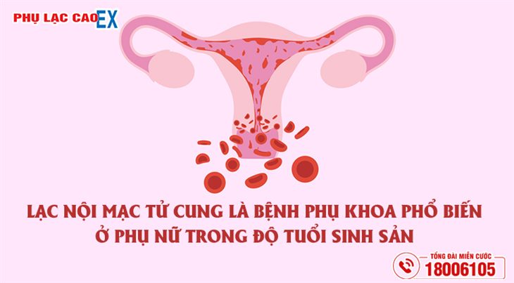 Lạc nội mạc tử cung là bệnh phụ khoa phổ biến ở phụ nữ trong độ tuổi sinh sản