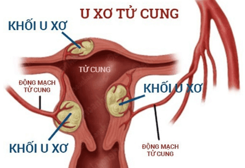 U xơ tử cung giai đoạn đầu thường ít có triệu chứng đặc trưng