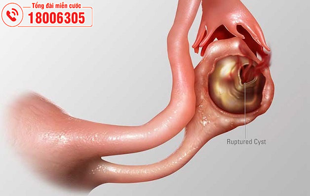 Vỡ u nang buồng trứng gây nguy hiểm đến tính mạng người bệnh