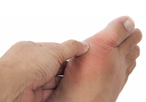 Bệnh gút thường gây sưng, đau ở ngón chân cái