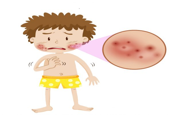 Vảy phấn đỏ nang lông thể điển hình ở trẻ em