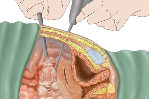 Phẫu thuật bóc tách là một phương pháp điều trị lạc nội mạc tử cung