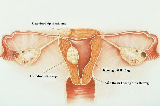 U xơ tử cung dưới thanh mạc thường gây đau vùng chậu