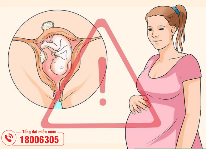 Sau mổ u xơ tử cung nếu mang thai sớm sẽ gặp nhiều rủi ro