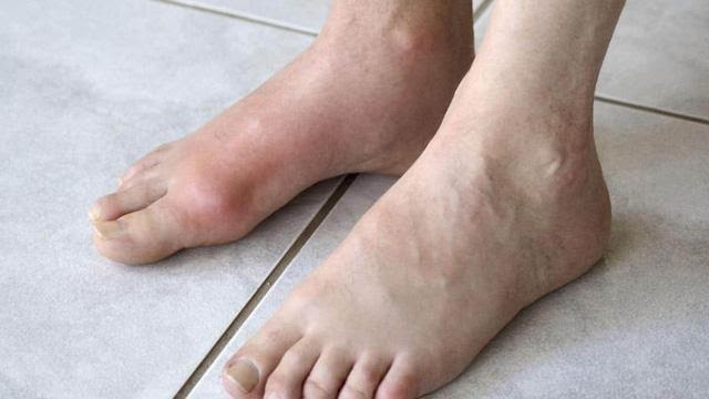 Bệnh gút thường gây đau ở khớp ngón chân