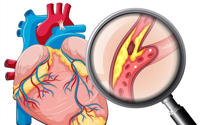   Nếu không điều trị tốt, suy thận độ 1 có thể gây biến chứng tim mạch