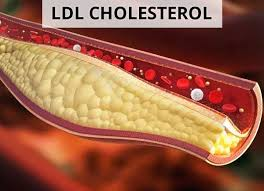 LDL-cholesterol tăng trong máu dẫn đến lắng đọng ở thành mạch máu