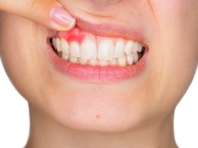 Viêm lợi là nguyên nhân gây tự nhiên chảy máu chân răng