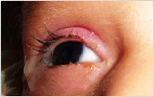 Thủy đậu mọc ở mắt làm giảm thị giác của người bệnh