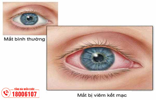 Thủy đậu mọc trong mắt có thể gây viêm kết mạc