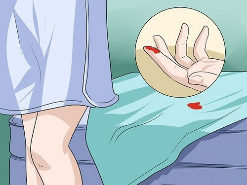U nang buồng trứng dạng đặc có thể gây chảy máu âm đạo bất thường