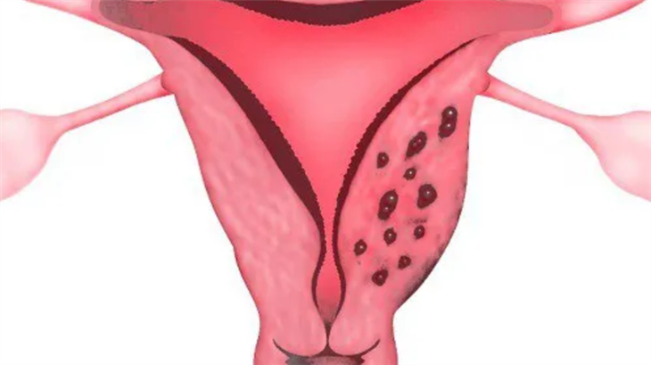 Các mô nội mạc phát triển ở thành cơ tử cung được gọi là lạc nội mạc tử cung trong cơ