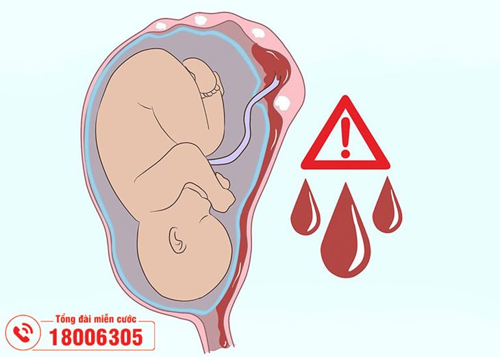 Nhân xơ tử cung có thể khiến thai nhi chậm phát triển