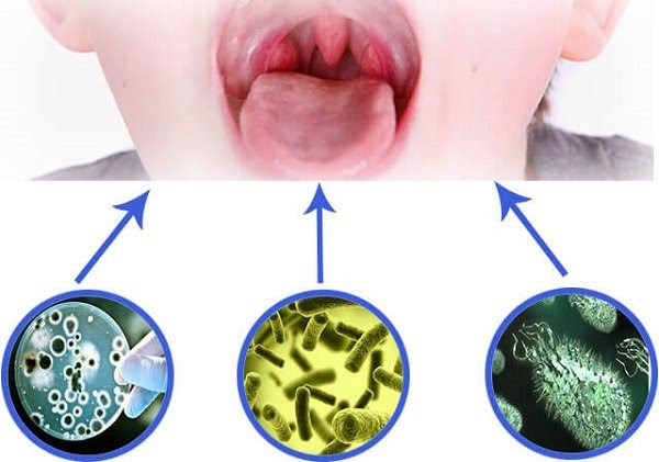 Viêm họng ở trẻ thường do virus, vi khuẩn gây ra