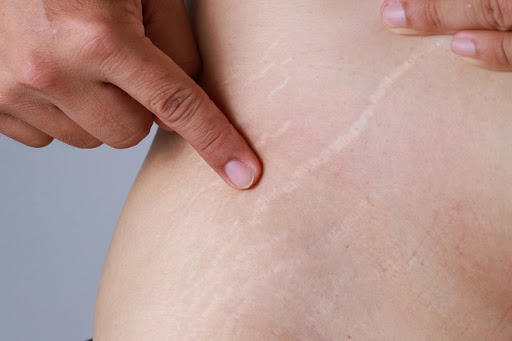 Nguyên nhân gây rạn da là do da bị kéo căng khiến các mô liên kết đứt gãy