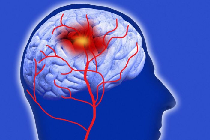 Tai biến mạch máu não là tình trạng tổn thương nghiêm trọng ở mạch máu não