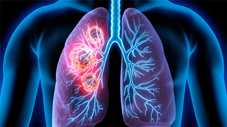 Khối u phổi chèn ép khí quản gây khó thở