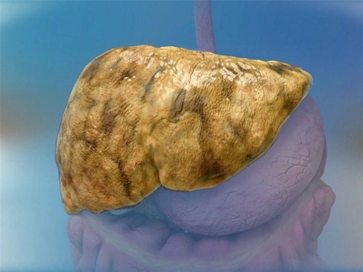 Gan nhiễm mỡ là tình trạng ứ đọng mỡ trong gan