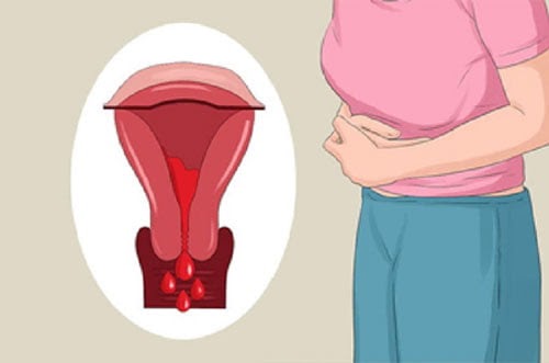 Lạc nội mạc tử cung thường gây rong kinh kéo dài