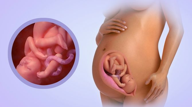 U xơ tử cung dưới thanh mạc có cuống khiến thai nhi chậm phát triển